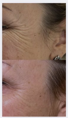 Botox Services - New to Botox? We specialize in conservative, education-focused treatments. Every appointment includes a one-on-one consultation to review facial anatomy, goals, and expected outcomes so you feel informed and confident in your care.