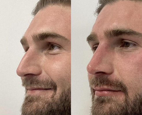 Non-Surgical Nose Job - Nonsurgical rhinoplasty is a cosmetic procedure where dermal fillers are used to temporarily change the shape of your nose. It’s an alternative for people who don’t want to undergo plastic surgery. Your healthcare provider can complete the treatment in one office visit. Results typically last up to six months.