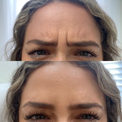 Botox - Botox® Cosmetic is a neurotoxin that is injected into the muscle for temporary relaxation of fine lines and wrinkles caused by age, repeated facial expressions, and overexposure to the sun. Botox® Cosmetic takes a few minutes to perform, in fact, it’s known as the “lunchtime procedure.”

 - On the forehead (frown lines)
 - Vertically or horizontally in between the eyes (brow furrows or glabellar) and/or the crow’s feet or laughter lines around the eyes.
 - To correct a “gummy” looking smile
 - To soften upper lip lines, and "flip" upper lip
 - On “bunny line” wrinkles either side of the nose
 - In the chin to correct “chin-ullite” bumpy chin
 - In the masseter muscles to slim the face, and help with teeth grinding
 - In the platysmal bands

The procedure is safe, not painful and is quick to perform.

Although there are different types of Botulinum A toxin on the market, but they are NOT the same as Botox® Cosmetic. As expert injectors, we have utilized many different brands of neurotoxins, and have come to find that many people don’t tolerate these other brands well. At Beauty Boost Med Spa, Inc. we strive for perfection and want our patients to receive the best products out there. We chose to use Botox® Cosmetic as our neurotoxin of choice due to its consistent results and longevity.
