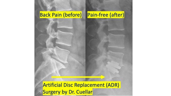 Total disc replacement surgery in the low back by Dr Jason Cuellar in Palm Beach and Jupiter Florida - Dr Jason M Cuellar is a board certified orthopedic spine surgeon that is a world expert in spine disc replacement surgery to treat neck and low back pain from disc herniation and disc degeneration. Total disc replacement surgery in the low back by Dr Jason Cuellar in Palm Beach and Jupiter Florida - Dr Jason M Cuellar is a board certified orthopedic spine surgeon that is a world expert in spine disc replacement surgery to treat neck and low back pain from disc herniation and disc degeneration.