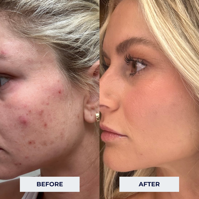 Intro Level 1 DMK Enzyme Restore Treatment "Plasmatic Glow" - These before/after images show a client's transformation after just one customized facial! DMK Enzyme therapy is an elite treatment for those who want RESULTS! This treatment delivers growth factors and nutrients to the skin as a way of rebuilding it from the inside out and reversing cell damage, restores your skin to its peak condition. It is a wonderfully unique experience that you will enjoy and your skin will glow immediately after! Intro Level 1 DMK Enzyme Restore Treatment "Plasmatic Glow" - These before/after images show a client's transformation after just one customized facial! DMK Enzyme therapy is an elite treatment for those who want RESULTS! This treatment delivers growth factors and nutrients to the skin as a way of rebuilding it from the inside out and reversing cell damage, restores your skin to its peak condition. It is a wonderfully unique experience that you will enjoy and your skin will glow immediately after!