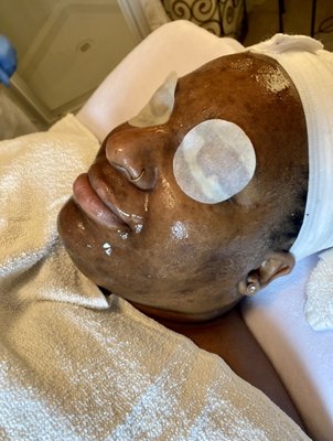 Effective Facial Brightening Skin Services - Repechage provides an effective facial treatment with hyperpigmented skin for every Fritzpatrick level.