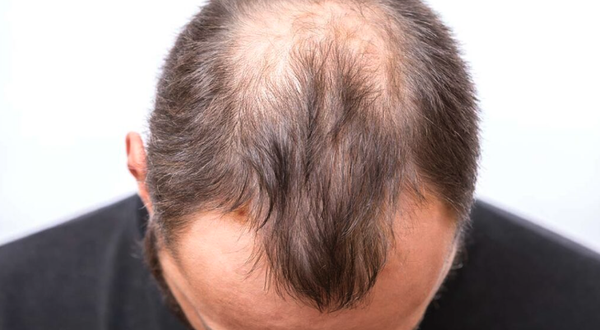 Hair Restoration - Welcome to our hair loss rejuvenation portfolio, where confidence meets innovation! Explore our showcase of successful transformations, showcasing the power of laser therapy in revitalizing hair. Witness the remarkable results as we help restore thicker, healthier hairlines using cutting-edge technology and personalized care. Discover how our treatments redefine possibilities and reignite self-assurance, one follicle at a time. Hair Restoration - Welcome to our hair loss rejuvenation portfolio, where confidence meets innovation! Explore our showcase of successful transformations, showcasing the power of laser therapy in revitalizing hair. Witness the remarkable results as we help restore thicker, healthier hairlines using cutting-edge technology and personalized care. Discover how our treatments redefine possibilities and reignite self-assurance, one follicle at a time.