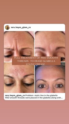 Custom treatment plan: Botox, PDO threads, skin care - This model had a deep crease in her glabella (11’s) at rest. With the use of PDO threads and neurotoxins such as Botox we were able to eliminate that crease. The lack of muscle contraction over time was stopped with the Botox and the PDO threads when dissolve make the body produce its own collagen to fill in the crease. This technique can be used in multiple areas of the face and body to turn back the clock and produce beautiful results. Custom treatment plan: Botox, PDO threads, skin care - This model had a deep crease in her glabella (11’s) at rest. With the use of PDO threads and neurotoxins such as Botox we were able to eliminate that crease. The lack of muscle contraction over time was stopped with the Botox and the PDO threads when dissolve make the body produce its own collagen to fill in the crease. This technique can be used in multiple areas of the face and body to turn back the clock and produce beautiful results.
