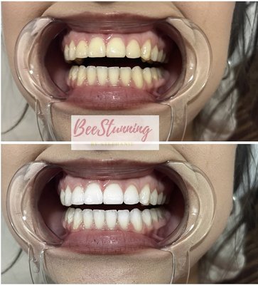 Teeth Whitening - Teeth whitening services and classes available! Want to be your own boss? Let me help you in one of the most leading industry’s multiple packages available and afterpay available to help make it easier 🥰 contact me for more info! Teeth Whitening - Teeth whitening services and classes available! Want to be your own boss? Let me help you in one of the most leading industry’s multiple packages available and afterpay available to help make it easier 🥰 contact me for more info!