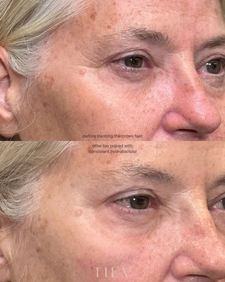 Neurotoxin - TOX: Experience the power of our muscle-melting protein! Say farewell to aging signs with Jeuveau, our favorite neurotoxin. We've got Dysport too! Smooth away those fine lines and embrace a youthful glow. Neurotoxin - TOX: Experience the power of our muscle-melting protein! Say farewell to aging signs with Jeuveau, our favorite neurotoxin. We've got Dysport too! Smooth away those fine lines and embrace a youthful glow.