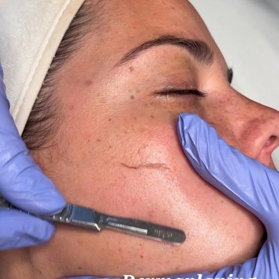 Dermaplaning - Dermaplaning, also known as the "Red Carpet Ready" facial is a minimally invasive cosmetic procedure that removes the top layers of skin to treat a variety of skin concerns and giving you an instant luminous glow lasting days.
Acne scars: Dermaplaning can reduce the appearance of deep acne scars by revealing newer, undamaged skin.
Skin texture: Dermaplaning can even out skin texture and make it smoother and brighter.
Unwanted hair: Dermaplaning can remove peach fuzz and other fine facial hairs.
Fine lines and wrinkles: Dermaplaning can reduce the appearance of fine lines and wrinkles.
Dry or dull skin: Dermaplaning can treat dry or dull skin.
Sun damage: Dermaplaning can treat sun-damaged skin. Dermaplaning - Dermaplaning, also known as the "Red Carpet Ready" facial is a minimally invasive cosmetic procedure that removes the top layers of skin to treat a variety of skin concerns and giving you an instant luminous glow lasting days.
Acne scars: Dermaplaning can reduce the appearance of deep acne scars by revealing newer, undamaged skin.
Skin texture: Dermaplaning can even out skin texture and make it smoother and brighter.
Unwanted hair: Dermaplaning can remove peach fuzz and other fine facial hairs.
Fine lines and wrinkles: Dermaplaning can reduce the appearance of fine lines and wrinkles.
Dry or dull skin: Dermaplaning can treat dry or dull skin.
Sun damage: Dermaplaning can treat sun-damaged skin.
