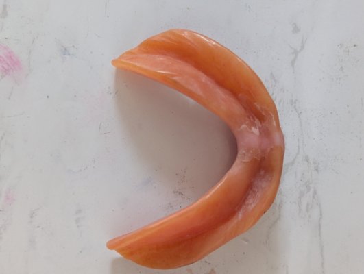 denture repair - Pt called with broken lower denture TWDR saw PT and same day had teeth repaired without an issues denture repair - Pt called with broken lower denture TWDR saw PT and same day had teeth repaired without an issues