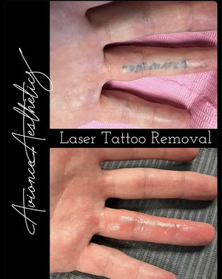 Tattoo Removal - Remove those unwanted, tattoos, using our state of the art laser tattoo removal machine! Results may vary depending on tattoo age, color, depth, etc.  
Book your consultation today to find out how easy it can be!