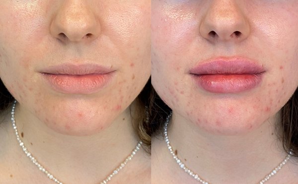 Dermal Fillers - Effective and immediate treatment for wrinkles, lines, and adding volume.