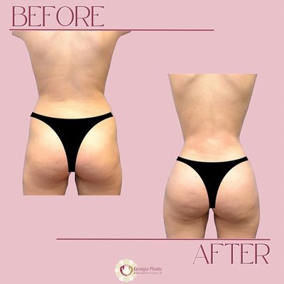 A little Liposuction goes a long way - If you are looking for an elegant shape with curves and have some fat to move around, this procedure is for YOU! In Atlanta GA, Dr. Okoro uses his own special state-of-the-art technique to naturally and strategically transfer fat into the buttocks. A little Liposuction goes a long way - If you are looking for an elegant shape with curves and have some fat to move around, this procedure is for YOU! In Atlanta GA, Dr. Okoro uses his own special state-of-the-art technique to naturally and strategically transfer fat into the buttocks.