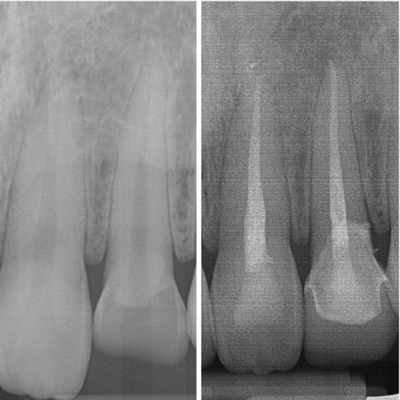 Root Canals - Root Canal Cases at Fuller Smiles