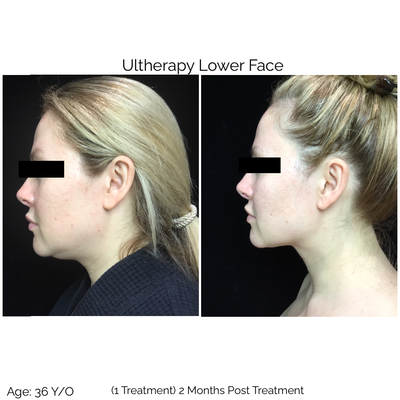 Ultherapy + Coolsculpting under the chin - Ultherapy uses ultrasound to generate collagen underneath the skin to tighten and lift, while Juvederm such as Juvederm Voluma XC can replenish the volume lost through normal aging. This is a great combination. Ask for an in person consultation with Dr Sheena Kong. During your appointment, Dr Kong will review to best address your personal aesthetic concerns while provide the most effective treatment plan to optimize your facial rejuvenation. Ultherapy + Coolsculpting under the chin - Ultherapy uses ultrasound to generate collagen underneath the skin to tighten and lift, while Juvederm such as Juvederm Voluma XC can replenish the volume lost through normal aging. This is a great combination. Ask for an in person consultation with Dr Sheena Kong. During your appointment, Dr Kong will review to best address your personal aesthetic concerns while provide the most effective treatment plan to optimize your facial rejuvenation.