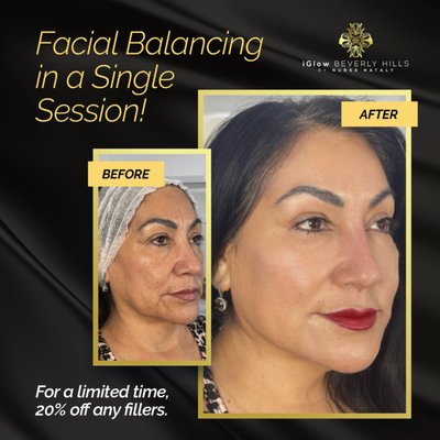 Liquid Facelift - Perfected by Nurse Nataly, a Liquid Face Lift is a combination of injectables (i.e. Botox, Juvederm, Voluma, etc).  Each patient is unique in structure and volume loss. Upon consultation, Nurse Nataly can pinpoint exactly where you have lost volume. With the right tools, Nurse Nataly can restore you to your natural, youthful lift.
A liquid facelift leaves you with beautifully natural results. It helps to balance facial features by restoring the natural contours of your face. Fine lines and wrinkles are diminished and sagging or loose skin, such as jowls, are lifted and rejuvenated.