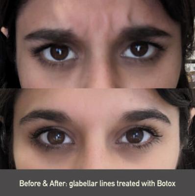Glabellar Botox Before & After - As we become older, bothersome signs of sun-damage, genetics, and aging are inevitable. Fine lines and wrinkles can have an adverse effect on how people perceive us, as well as, our self-image. Consequently, every aspect of our lives from work to social events can trigger anxiety.
If this sounds familiar, you’re not alone. Millions of Americans request BOTOX® Cosmetics to treat their aesthetic concerns. In fact, BOTOX® Cosmetics remains the number one non-surgical procedure asked for on the market today.
Call today to schedule your appointment! Glabellar Botox Before & After - As we become older, bothersome signs of sun-damage, genetics, and aging are inevitable. Fine lines and wrinkles can have an adverse effect on how people perceive us, as well as, our self-image. Consequently, every aspect of our lives from work to social events can trigger anxiety.
If this sounds familiar, you’re not alone. Millions of Americans request BOTOX® Cosmetics to treat their aesthetic concerns. In fact, BOTOX® Cosmetics remains the number one non-surgical procedure asked for on the market today.
Call today to schedule your appointment!