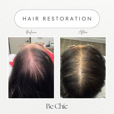 Hair Restoration - Unlock your hair's full potential with PRP and Keravive-Hydrafacial: where science meets stunning transformations! Hair Restoration - Unlock your hair's full potential with PRP and Keravive-Hydrafacial: where science meets stunning transformations!