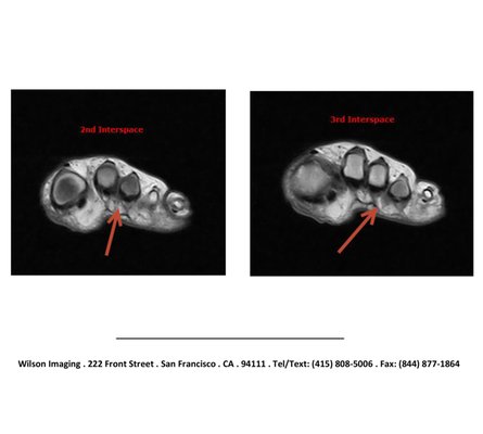 Case history of Morton's Neuroma - This MRI case study presents a comprehensive diagnosis of worsening forefoot pain in a 51-year-old female patient. Let’s break down the key elements of this case to better understand the diagnosis and the role of MRI in this context.
An initial diagnosis of Morton’s neuroma in the 3rd interspace was made based on a clinical exam by a podiatrist. However, subsequent MRI findings revealed an additional neuroma in the 2nd interspace. This case highlights the essential role of MRI in accurately determining the full extent of the pathology and correcting initial misdiagnoses, thus enabling more effective treatment planning.
MRI provides detailed images of bone and soft tissue, making it ideal for complex foot structures. It is frequently highlighted as the reference standard for imaging soft tissue structures, such as Morton's neuroma, due to its high sensitivity (87%) and specificity1,. Since MRI does not use radiation, it is a safe, convenient, and affordable ($499) diagnostic modality that is effective in identifying foot pathology due to its high-resolution images that allow for detailed evaluation of soft tissue structures, which is not possible with X-rays. Case history of Morton's Neuroma - This MRI case study presents a comprehensive diagnosis of worsening forefoot pain in a 51-year-old female patient. Let’s break down the key elements of this case to better understand the diagnosis and the role of MRI in this context.
An initial diagnosis of Morton’s neuroma in the 3rd interspace was made based on a clinical exam by a podiatrist. However, subsequent MRI findings revealed an additional neuroma in the 2nd interspace. This case highlights the essential role of MRI in accurately determining the full extent of the pathology and correcting initial misdiagnoses, thus enabling more effective treatment planning.
MRI provides detailed images of bone and soft tissue, making it ideal for complex foot structures. It is frequently highlighted as the reference standard for imaging soft tissue structures, such as Morton's neuroma, due to its high sensitivity (87%) and specificity1,. Since MRI does not use radiation, it is a safe, convenient, and affordable ($499) diagnostic modality that is effective in identifying foot pathology due to its high-resolution images that allow for detailed evaluation of soft tissue structures, which is not possible with X-rays.
