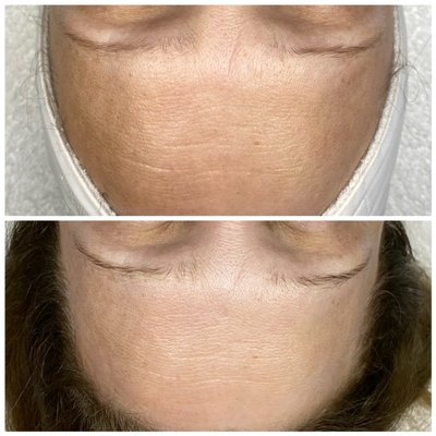 Procell Microchanneling - Procell Microchanneling, a collagen induction therapy facial that triggers the skins natural ability to heal itself. Better than Botox and long lasting results. We use a .25mm needle stamp to create thousands of uniform channels in the skin and then we induce hyaluronic acid and growth factors that will produce the highest quality collagen and elastin, the proteins that make up the skin to reduce fine lines & wrinkles, diminish acne scars, reduce rosacea, tighten pores & even out overall skin tone & texture. No downtime & amazing results!