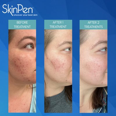 SkinPen Microneedling - SkinPen is FDA-approved to improve skin texture, minimize acne scarring/pore size and build collagen.