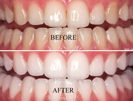 A Smile You'll Love - Whitening products contain one of two tooth bleaches (hydrogen peroxide or carbamide peroxide). These bleaches break stains into smaller pieces, which makes the color less concentrated and your teeth brighter. Smile brighter today at The Tooth Fairy.