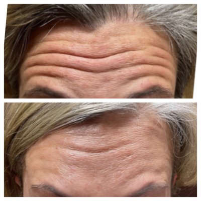 Before and Afters - "Lip Flip" with botox, a pout enhancement, only takes a 4 to 6 units of botox and a few mins to complete.