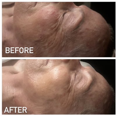 First facial! - This beautiful lady came to me for her first facial! This is just after one treatment of Korean treatment called Carboxy & VTox. Beautiful results!