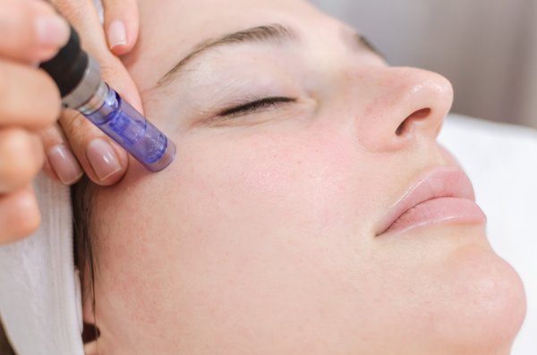 Microneedling - Microneediling facial is an innovative skin rejuvenation treatment, microneediling is a form of Collagen Induction Therapy that significantly improves the appearance of sun damage, fine lines, wrinkles, acne scars, and stretch marks with little downtime.
This procedure uses tiny needles to pierce the skin allowing new collagen to grow. it stimulates the natural production of new collagen and elastin in the skin.

It helps improve:
• Sun damage (sun spots)
• Age and brown spots
• Fine lines and wrinkles
• Laugh lines
• Stretch marks
• Acne scarring
• Uneven skin tone
• Large pore size

How many treatment will I need?
The healing process begins almost immediately. Your skin will look smoother and more radiant in a week following your microneedling treatment at Faciallash Lounge. Results are gradual, with incremental improvement with each microneedling session. It depends on the health of your skin and your desired results. For optimal result, we recommend a series of 3 to 5 microneedling treatments spaced approximately 4 weeks apart.