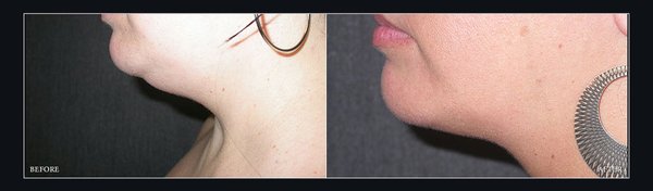 Liposuction - A surgical procedure designed to remove excess fat and flatten bulges. It is most effective for treatment of localized fat deposits, to improve shape and body contour, rather than for treatment of generalized obesity. Even fit patients who exercise and control their diet may have stubborn accumulations of fat that remain no matter what they do. Liposuction removes fat and fat cells, sculpting the body in a way that exercise alone sometimes cannot. Liposuction can be an especially excellent and gratifying solution for treating abdominal fat, love handles or prominent hips, rolls of tissue in the back near the bra strap, bulges on the inner or outer thighs, or prominence below the buttocks crease on the back of the thighs (“banana roll”).
One attractive benefit of liposuction is the minimal scarring. The fat is suctioned through very small incisions that can usually be hidden in natural skin creases, or placed in locations which can be easily hidden with most clothing, underwear or swimsuits. Liposuction - A surgical procedure designed to remove excess fat and flatten bulges. It is most effective for treatment of localized fat deposits, to improve shape and body contour, rather than for treatment of generalized obesity. Even fit patients who exercise and control their diet may have stubborn accumulations of fat that remain no matter what they do. Liposuction removes fat and fat cells, sculpting the body in a way that exercise alone sometimes cannot. Liposuction can be an especially excellent and gratifying solution for treating abdominal fat, love handles or prominent hips, rolls of tissue in the back near the bra strap, bulges on the inner or outer thighs, or prominence below the buttocks crease on the back of the thighs (“banana roll”).
One attractive benefit of liposuction is the minimal scarring. The fat is suctioned through very small incisions that can usually be hidden in natural skin creases, or placed in locations which can be easily hidden with most clothing, underwear or swimsuits.