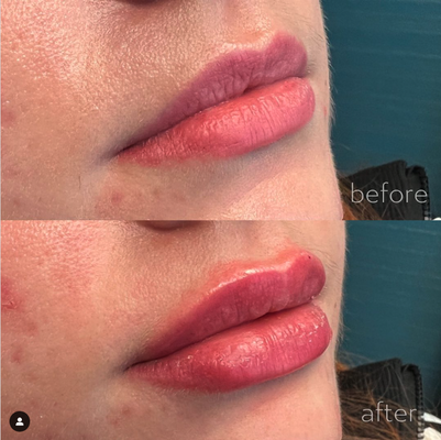 Lip Filler Injections - Our expert injectors use a wide range of hyaluronic acid fillers to deliver subtle, soft, natural lip enhancement results.