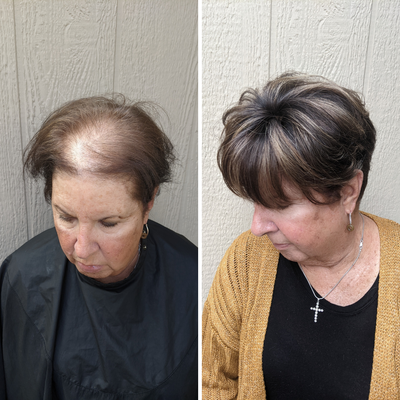 Non Surgical Hair Replacement - This client has thinning hair and wanted a solution that allowed her to do all of her regular life activities without worrying about her hair. We used a Microlines piece to fill in her thinning giving her the full thick hair she used to have. Non Surgical Hair Replacement - This client has thinning hair and wanted a solution that allowed her to do all of her regular life activities without worrying about her hair. We used a Microlines piece to fill in her thinning giving her the full thick hair she used to have.