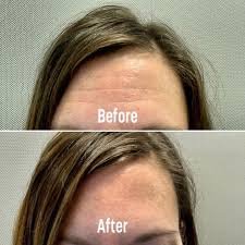 botox - BOTOX can be used on the forehead lines, frown lines, crow's feet, lines in/around the nose, chin area for dimpling, skin bands on the neck, and around the mouth for smoker's lines and down-turned corners of the mouth. Botox is NOT a facial filler, it relaxes the muscles that are creating those wrinkles. botox - BOTOX can be used on the forehead lines, frown lines, crow's feet, lines in/around the nose, chin area for dimpling, skin bands on the neck, and around the mouth for smoker's lines and down-turned corners of the mouth. Botox is NOT a facial filler, it relaxes the muscles that are creating those wrinkles.