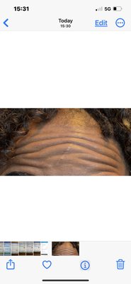 Botox Injections (Jeuveau) of the Frontalis  and Comma Lines - The first picture was taken two weeks  prior to injection of Jeuveau into the frontalis and comma lines . The second is two weeks following. As you can see the results are amazing !!!!