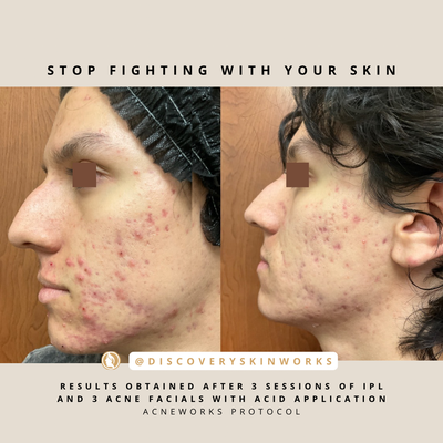 Acne Treatments - Existing and in process results from some of our acne and acne scarring patients!