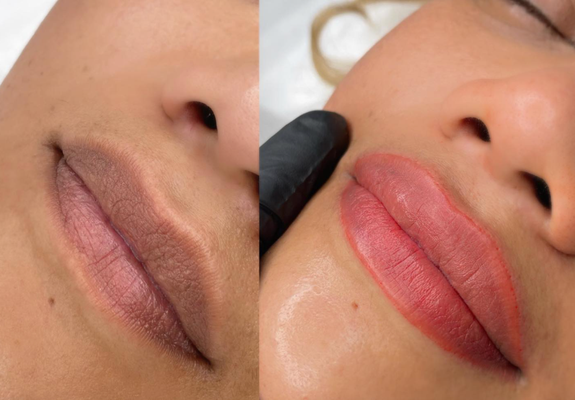 Lip Neutralization - At Yara's Glow Studio, lip neutralization is a specialized semi-permanent cosmetic procedure designed to lighten and balance the natural pigmentation of your lips. Depending on the darkness of your natural lip color, this process may take a few sessions to achieve your desired lighter look. This technique is perfect for individuals with darker or uneven lip tones, providing a fresh, more uniform appearance.