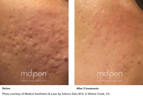 Microneedling - Microneedling is a cosmetic procedure that uses small, sterilized needles to prick the skin while either applying Hyaluronic acid, platelet-rich Fibrin (PRF) or platelet-rich plasma (PRP) to stimulate collagen production. Platelets help blood clot, so they are vital for healing wounds and injuries.The purpose of this treatment is encourage collagen production by taking advantage of the body’s natural healing response causing the skin tissue to become more smooth, firm and toned. Microneedling - Microneedling is a cosmetic procedure that uses small, sterilized needles to prick the skin while either applying Hyaluronic acid, platelet-rich Fibrin (PRF) or platelet-rich plasma (PRP) to stimulate collagen production. Platelets help blood clot, so they are vital for healing wounds and injuries.The purpose of this treatment is encourage collagen production by taking advantage of the body’s natural healing response causing the skin tissue to become more smooth, firm and toned.