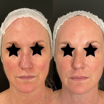 COOLPEEL Deka - CoolPeel is a cutting-edge non-ablative laser therapy celebrated for its skin resurfacing effectiveness. This advanced procedure uses a precise CO2 laser to target the skin's outermost layer, efficiently removing damaged skin cells. By delivering energy in short pulses, CoolPeel stimulates collagen production and creates microchannels in the skin. These microchannels activate the body's natural healing processes, resulting in improved skin texture and tone, reduced wrinkles, and smaller pores. COOLPEEL Deka - CoolPeel is a cutting-edge non-ablative laser therapy celebrated for its skin resurfacing effectiveness. This advanced procedure uses a precise CO2 laser to target the skin's outermost layer, efficiently removing damaged skin cells. By delivering energy in short pulses, CoolPeel stimulates collagen production and creates microchannels in the skin. These microchannels activate the body's natural healing processes, resulting in improved skin texture and tone, reduced wrinkles, and smaller pores.