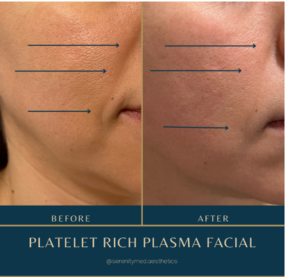 PRP with Microneedling for Facial Rejuvenation - Platelet-Rich Plasma (PRP) + Microneedling combines the collagen stimulating benefits of microneedling with the regenerative properties of PRP. PRP is a substance derived from the patient's own blood, rich in growth factors and platelets that can promote tissue healing and regeneration, resulting in smoother, firmer skin with improved texture, reduced wrinkles and a healthier, more radiant complexion.