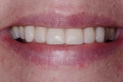 Digital Dentistry, Real Results: Lisa’s Smile Makeover Journey - Lisa came to Lawson Dentistry feeling that her smile didn’t reflect the vibrant person she truly was. Her teeth had become noticeably shorter and more worn than what’s typical for her age—giving her a prematurely aged appearance that deeply affected her confidence. The root causes were complex, stemming from chronic grinding and sleep apnea-related gastrointestinal issues. These functional health challenges had, over time, taken a toll on both the aesthetics and structure of her teeth.
Wanting to feel more confident and look as youthful as she felt inside, Lisa sought a solution that would not only restore the appearance of her smile but also improve its function. She found that solution at Lawson Dentistry, where Dr. Jessica Lawson crafted a plan centered around restoring her upper front teeth—the cosmetic zone of her smile. The goal was to help Lisa reclaim a more youthful appearance while also addressing the wear and tear that had compromised her teeth over the years.
To begin the transformation, our team used advanced digital technology that allowed Lisa to preview her new smile before any permanent changes were made. A digital scan of her mouth was taken and used to create a mock-up overlay of what her restored teeth would look like. This gave Lisa the opportunity to see and approve the proposed improvements, offering peace of mind and excitement for the road ahead.
For the veneer preparation, a digital scanner was used to avoid traditional, uncomfortable impressions. This gag-free approach allowed for precise imaging and ensured a snug, comfortable fit for her final restorations. The use of digital scanning also improved communication with the dental lab, helping us deliver results that closely matched Lisa’s desired outcome.
But Lisa’s smile transformation wasn’t just about appearance—it was about wellness, too. Because grinding and sleep apnea were major contributors to the wear on her teeth, it was critical to address the root causes to prevent future damage. As part of her treatment, Lisa received a 3D-printed, custom-made nylon appliance designed to reduce snoring and improve sleep quality. Lightweight, durable, and comfortable, the appliance helped Lisa breathe better at night and significantly reduced her snoring—so much so that her friends and loved ones noticed the change.
With her treatment complete, the results were nothing short of transformative. Lisa’s teeth now had a more youthful shape and brightness, giving her a smile that looked natural, healthy, and vibrant. But the transformation went deeper than that. For the first time in years, Lisa felt confident enough to smile openly and show her teeth without hesitation.
What made this case especially memorable for our office was the moment we handed Lisa the mirror after her final appointment. Watching her reaction—seeing the tears, the smile, and the realization of just how far she had come—was a powerful reminder of why we do what we do. It wasn’t just about fixing teeth; it was about restoring confidence, comfort, and quality of life.
Lisa was so thrilled with her results that she shared her story on Google, complete with before-and-after photos. Her heartfelt testimonial described not only how much younger and more confident she felt, but how the treatment had improved her day-to-day life in unexpected ways.
At Lawson Dentistry, we are committed to providing more than just cosmetic improvements. We take a comprehensive, health-focused approach to smile design—because when your smile is healthy and functional, it shows. Lisa’s story is a perfect example of what’s possible when advanced technology, personalized care, and thoughtful planning come together to change someone’s life for the better. Digital Dentistry, Real Results: Lisa’s Smile Makeover Journey - Lisa came to Lawson Dentistry feeling that her smile didn’t reflect the vibrant person she truly was. Her teeth had become noticeably shorter and more worn than what’s typical for her age—giving her a prematurely aged appearance that deeply affected her confidence. The root causes were complex, stemming from chronic grinding and sleep apnea-related gastrointestinal issues. These functional health challenges had, over time, taken a toll on both the aesthetics and structure of her teeth.
Wanting to feel more confident and look as youthful as she felt inside, Lisa sought a solution that would not only restore the appearance of her smile but also improve its function. She found that solution at Lawson Dentistry, where Dr. Jessica Lawson crafted a plan centered around restoring her upper front teeth—the cosmetic zone of her smile. The goal was to help Lisa reclaim a more youthful appearance while also addressing the wear and tear that had compromised her teeth over the years.
To begin the transformation, our team used advanced digital technology that allowed Lisa to preview her new smile before any permanent changes were made. A digital scan of her mouth was taken and used to create a mock-up overlay of what her restored teeth would look like. This gave Lisa the opportunity to see and approve the proposed improvements, offering peace of mind and excitement for the road ahead.
For the veneer preparation, a digital scanner was used to avoid traditional, uncomfortable impressions. This gag-free approach allowed for precise imaging and ensured a snug, comfortable fit for her final restorations. The use of digital scanning also improved communication with the dental lab, helping us deliver results that closely matched Lisa’s desired outcome.
But Lisa’s smile transformation wasn’t just about appearance—it was about wellness, too. Because grinding and sleep apnea were major contributors to the wear on her teeth, it was critical to address the root causes to prevent future damage. As part of her treatment, Lisa received a 3D-printed, custom-made nylon appliance designed to reduce snoring and improve sleep quality. Lightweight, durable, and comfortable, the appliance helped Lisa breathe better at night and significantly reduced her snoring—so much so that her friends and loved ones noticed the change.
With her treatment complete, the results were nothing short of transformative. Lisa’s teeth now had a more youthful shape and brightness, giving her a smile that looked natural, healthy, and vibrant. But the transformation went deeper than that. For the first time in years, Lisa felt confident enough to smile openly and show her teeth without hesitation.
What made this case especially memorable for our office was the moment we handed Lisa the mirror after her final appointment. Watching her reaction—seeing the tears, the smile, and the realization of just how far she had come—was a powerful reminder of why we do what we do. It wasn’t just about fixing teeth; it was about restoring confidence, comfort, and quality of life.
Lisa was so thrilled with her results that she shared her story on Google, complete with before-and-after photos. Her heartfelt testimonial described not only how much younger and more confident she felt, but how the treatment had improved her day-to-day life in unexpected ways.
At Lawson Dentistry, we are committed to providing more than just cosmetic improvements. We take a comprehensive, health-focused approach to smile design—because when your smile is healthy and functional, it shows. Lisa’s story is a perfect example of what’s possible when advanced technology, personalized care, and thoughtful planning come together to change someone’s life for the better.