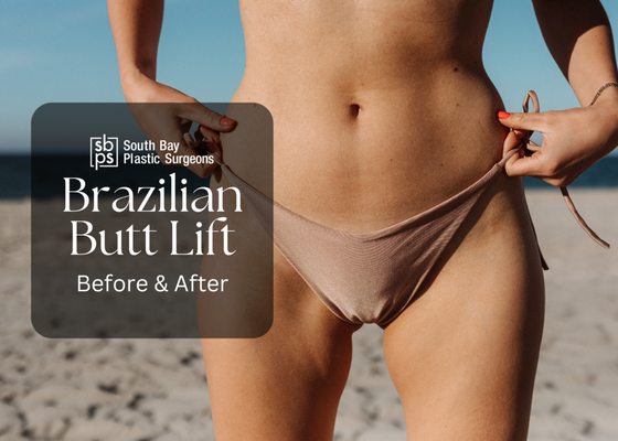 Brazilian Butt Lift - Los Angeles is the home of celebrity beauty trends, and the Brazilian butt lift (BBL) certainly qualifies as a procedure that’s become extremely popular because of a few well-known patients. The surgery takes fat from an area of the body where it’s unwanted and uses it to enhance the buttocks, providing the best of both worlds. Women and men considering a Brazilian butt lift travel from Manhattan Beach, Redondo Beach, and throughout the South Bay to our Torrance plastic surgery practice to have one of our board-certified plastic surgeons perform the procedure. Brazilian Butt Lift - Los Angeles is the home of celebrity beauty trends, and the Brazilian butt lift (BBL) certainly qualifies as a procedure that’s become extremely popular because of a few well-known patients. The surgery takes fat from an area of the body where it’s unwanted and uses it to enhance the buttocks, providing the best of both worlds. Women and men considering a Brazilian butt lift travel from Manhattan Beach, Redondo Beach, and throughout the South Bay to our Torrance plastic surgery practice to have one of our board-certified plastic surgeons perform the procedure.