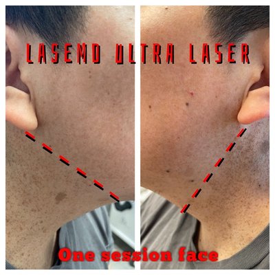 Pigmentation Treatment - We use a variety of pigment lasers, including the Hollywood Spectra, BBL/Halo, LaseMD Ultra, and other technologies to tackle hard to treat spots. Pigmentation Treatment - We use a variety of pigment lasers, including the Hollywood Spectra, BBL/Halo, LaseMD Ultra, and other technologies to tackle hard to treat spots.