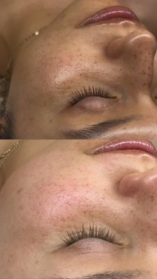 Micro-chanelling Facials - Improve scarring, fine lines, skin tone and texture with our minimally-invasive Micro-Channel treatment that stimulates collagen and elastin production.  With finer needles than Mirco-needling this treatment is safe for all skin types and tones and improves elasticity with minimal to no downtime.