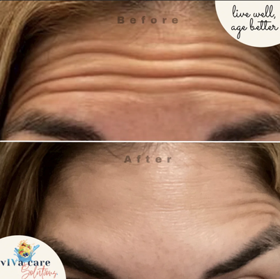 Botox - Botox in Philadelphia, PA, is suitable for adults who want to reduce the appearance of wrinkles and maintain a youthful appearance. Ideal candidates are those with mild to moderate wrinkles and good overall health. Results can usually be seen within 3-7 days after the treatment, with the full effect visible at around two weeks. The results typically last for three to four months. Regular follow-up treatments are advised to maintain the desired results. If you want to enhance your appearance with Botox, consider booking an appointment with Viva Care Solutions in Philadelphia, PA. Botox - Botox in Philadelphia, PA, is suitable for adults who want to reduce the appearance of wrinkles and maintain a youthful appearance. Ideal candidates are those with mild to moderate wrinkles and good overall health. Results can usually be seen within 3-7 days after the treatment, with the full effect visible at around two weeks. The results typically last for three to four months. Regular follow-up treatments are advised to maintain the desired results. If you want to enhance your appearance with Botox, consider booking an appointment with Viva Care Solutions in Philadelphia, PA.