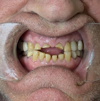 Bioclear before - Bioclear to rebuild extreme warm front upper teeth. Patient is scheduled to do lowers soon Bioclear before - Bioclear to rebuild extreme warm front upper teeth. Patient is scheduled to do lowers soon