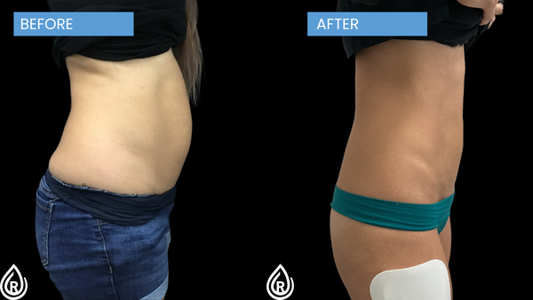 EmSculpt Neo - At Refresh Medical, we offer EMSCULPT NEO—a breakthrough, non-invasive body sculpting treatment that helps you burn stubborn fat and build muscle in just a few quick sessions. If you’re putting in the work at the gym and eating clean but still not seeing the results you want, EMSCULPT NEO uses advanced radiofrequency (RF) energy to melt away fat and high-intensity focused electromagnetic (HIFEM+) energy to strengthen and tone muscle at the same time. In as little as 30 minutes, you can burn up to 30% fat and boost muscle mass by up to 25% in targeted areas—all with no downtime, pain, or recovery. Our expert providers personalize every session to your body goals, so you can achieve a stronger, more sculpted look faster and more effectively than workouts alone. EmSculpt Neo - At Refresh Medical, we offer EMSCULPT NEO—a breakthrough, non-invasive body sculpting treatment that helps you burn stubborn fat and build muscle in just a few quick sessions. If you’re putting in the work at the gym and eating clean but still not seeing the results you want, EMSCULPT NEO uses advanced radiofrequency (RF) energy to melt away fat and high-intensity focused electromagnetic (HIFEM+) energy to strengthen and tone muscle at the same time. In as little as 30 minutes, you can burn up to 30% fat and boost muscle mass by up to 25% in targeted areas—all with no downtime, pain, or recovery. Our expert providers personalize every session to your body goals, so you can achieve a stronger, more sculpted look faster and more effectively than workouts alone.