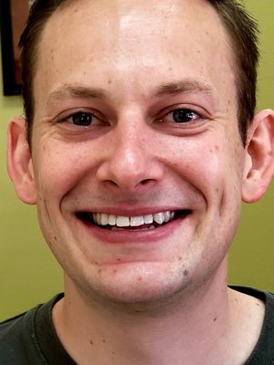 Teeth Whitening (In Office) - This young handsome man came a month before his wedding and ended up getting one of the fastest teeth whitening results ever. Now , He cannot stop smiling and showing off his pearly whites to the world.  The treatment was one visit and only 20 minutes long. He did follow the instructions prior to and after the treatment was provided. Congratulations ! Wish you all the best !!!
