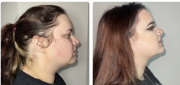 Kybella Jawline Augmentation - All models came in wanting a more defined jawline and dissolve unwanted fat under the skin. 
Kybella and jawline augmentations give the jawline a more contoured and structured appearance in the face and neck.