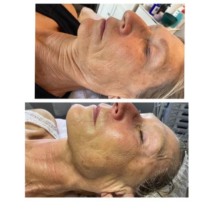 Bio-Peptide Lifting Treatment - Bio-Peptides work in harmony with the skin for optimum cellular communication. Our Bio-Activ peptides are formulated with pharmaceutical grade ingredients and higher peptide concentrations to provide advanced anti-aging treatments for true skin transformation. Peptides restore cellular communication and lay the foundation to a healthy skin barrier, improving cellular turnover and renewal for optimum skin health. This treatment has incredible lifting and diminishing lines and wrinkles. Bio-Peptide Lifting Treatment - Bio-Peptides work in harmony with the skin for optimum cellular communication. Our Bio-Activ peptides are formulated with pharmaceutical grade ingredients and higher peptide concentrations to provide advanced anti-aging treatments for true skin transformation. Peptides restore cellular communication and lay the foundation to a healthy skin barrier, improving cellular turnover and renewal for optimum skin health. This treatment has incredible lifting and diminishing lines and wrinkles.