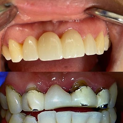 Implants Before and After - THe before and after pictures of patients work.