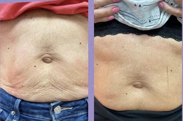 Skin Tightening Treatments - These are a few of our before and after Skin Tightening Treatments. Skin Tightening Treatments - These are a few of our before and after Skin Tightening Treatments.