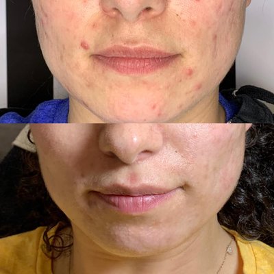 Microneeding to treat acne. - Notice how much better her acne improved after treatments. Microneeding helps release many of the bacteria trapped in the skin while inducing collagen and elastin production helping the skin heal and rid itself of acne. Microneeding to treat acne. - Notice how much better her acne improved after treatments. Microneeding helps release many of the bacteria trapped in the skin while inducing collagen and elastin production helping the skin heal and rid itself of acne.